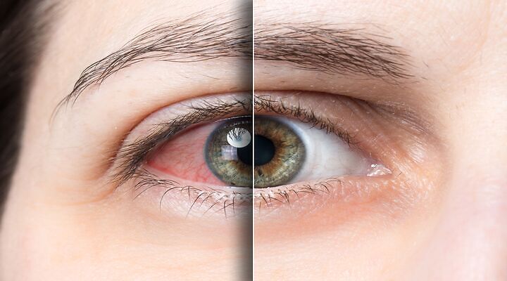 Suvo oko – Mogući uzroci i simptomi, lečenje i prevencija i zašto je važan suzni film