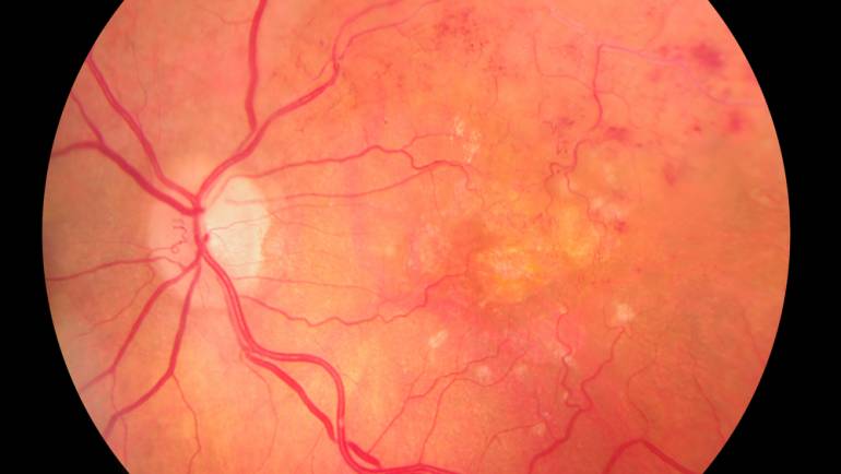 Okluzija centralne retinalne vene
