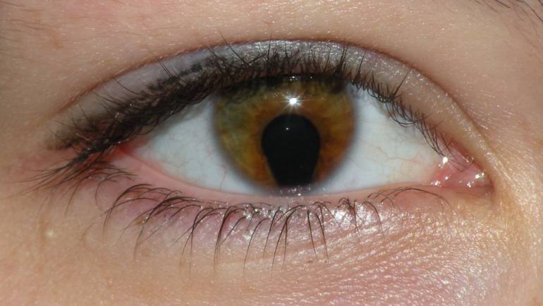 Kolobom –  Urođena deformacija gde nedostaje određeni deo očnog tkiva